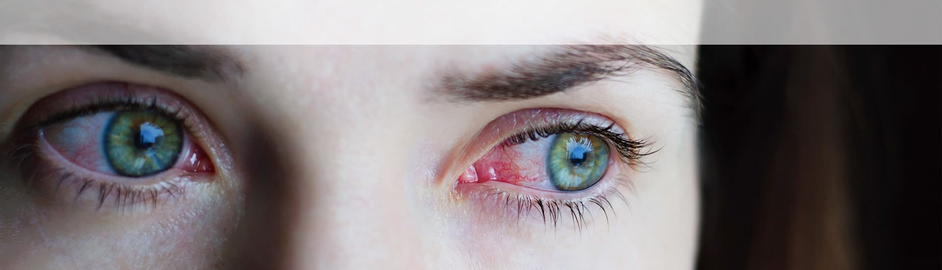 Conjunctivitis (Pink Eye) in Hawkesbury Hero
